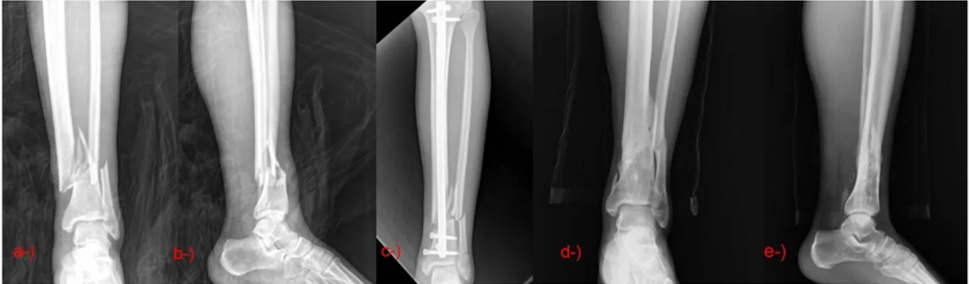 Figure 2: Thirty-one-year-old male AO/OTA type 43A3 a, b) Preoperative X-rays c) Early postoperative X-ray  d,e)Postoperative X-ray at 34 th month, removal of the nail after fracture healing due to deep infection 