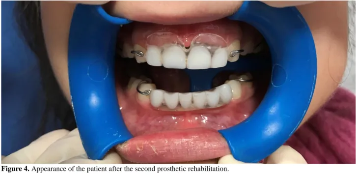 Figure 5. The appearance of the patient after the third prosthetic rehabilitation and the eruption of the tooth