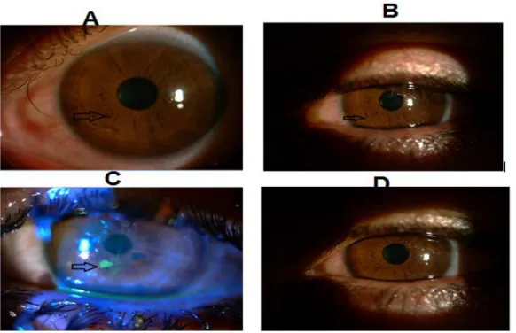 Figure 2.  Influence on the corneal structure of the metal spall deployed from cutting  and  grinding  A:  before  treatment,    B:  After  removal  of  the  metal  particle,    C:  The  performed by fluorescent staining after the removal of metal particle