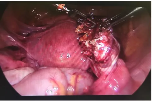 Figure 3. shown that a wedge resection was performed 