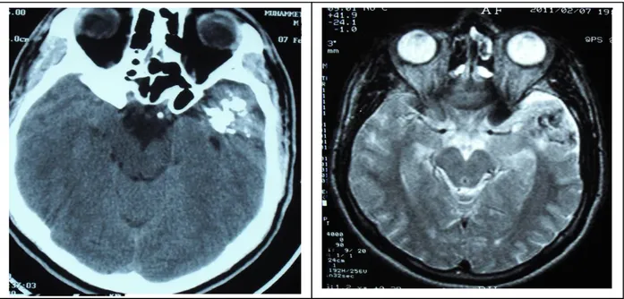 Şekil  1:  Beyin  BT  parankim  penceresi.  Aksiyel  kesitlerde  sol  temporal  lobda  kalsifiye  pilositik  astrositom