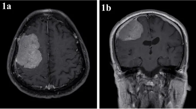 ġekil  1:  Kontrastlı  (1a:  aksiyel  ve  1b:  koronal  kesit)  Beyin  MR’da  sağ  frontopariyetel  bölgede  yaklaşık  70x50x35 mm boyutlarda, homojen kontrastlanan kitle görünümü