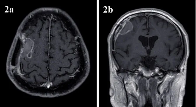 ġekil  2:  İlk  ameliyattan  3  hafta  sonra  çekilen  kontrastlı  (2a:  aksiyel  ve  2b:  koronal  kesit)    Beyin  MR’da  bir  önceki  cerrahi  alana  uygun  lokalizasyonda  hafif  çevresel  kontrastlanma  gösteren,  yaklaşık  30x20x15  mm  boyutlarında 