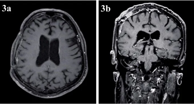 ġekil 3: İkinci operasyondan 3 ay sonra çekilen kontrastlı (3a: aksiyel ve 3b: koronal kesit) Beyin MR’da yer  kaplayan herhangi bir lezyon izlenmedi