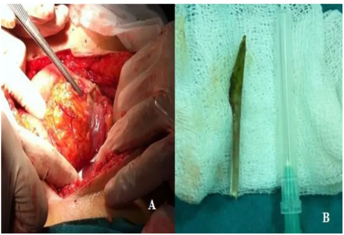 Figure 2: A) Intraoperative perforation foreign body in the stomach, one side inside the other  side outside the stomach
