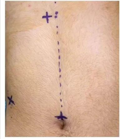 Fig 1. Location of ports in 3-port laparoscopic cholecystectomy, a 5-mm infra-umbilical port, a 5-mm subxyphoid  post and a 5-mm subcostal port (right lower quadrant at midclavicular line)  