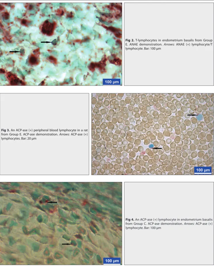 Fig 2. T-lymphocytes in endometrium basalis from Group  e. ANAe demonstration. Arrows: ANAe (+) lymphocyte/T  lymphocyte