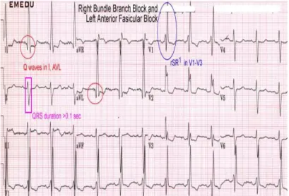 Figure 2.8: Right bundle branch block and left anterior fasicular block (Emedu, 2012) 