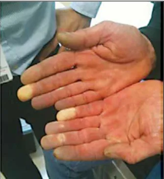 Fig. 1. Secondary Raynaud’s syndrome 