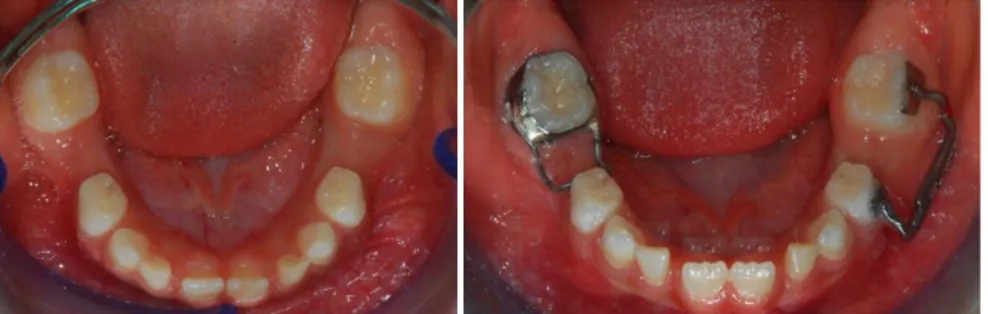 Şekil 2.7. Hastaya yer tutucu uygulanmadan önce ve uygulandıktan  sonraki ağız içi görünümleri