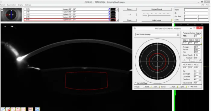 Figure 2. CD measurements were manually performed on the apex of the cornea.