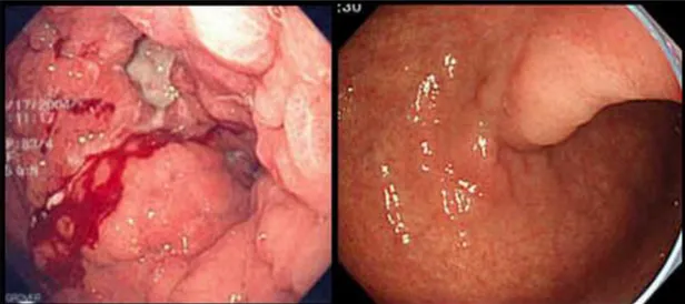 Şekil 2.11. İleri evre (solda) ve erken mide kanserinin endoskopik görünümü      (www.drahmetdobrucali.com) 