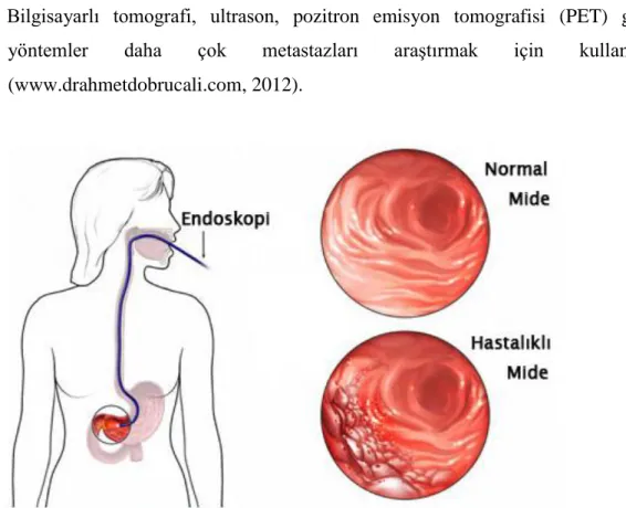 Şekil 2.12. Endoskopi uygulaması  (www.sinanersin.com)  2.4.7. Mide kanserinde evreleme 