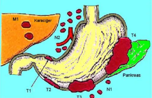 Şekil 2.13. Mide kanserinde tümörün evrelenmesi(www.drahmetdobrucali.com)