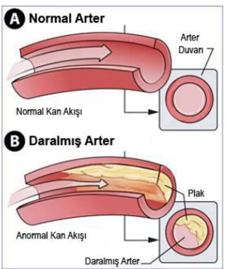 Şekil 2.1 Arterde plak oluşumuna bağlı damar lümeninde daralma meydana gelmesi  (Berke 2010) 