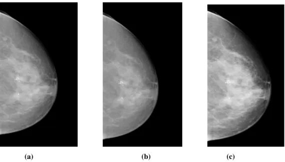 Şekil 5.2. (a) Orijinal mamogram görüntüsü (b) a=-45 değeri almış mamogram görüntüsü  (c) a=95 değeri almış mamogram görüntüsü