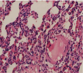 Şekil 7.Grup 3’teki ratlarda karaciğer parankim dokusu. Geniş safra kanalikülleri, periportal  mesafade ve vena sentralis çevresinde köprüleşme nekrozu, fibrozis ve mononükleer hücre  infiltrasyonu izlenmektedir (H&amp;EX100)