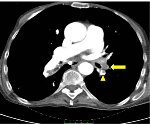 Şekil  3.1.  Pulmoner  arter  dallarında  total  (ok)  ve  parsiyel  trombüse  (ok  başı  )  ait dolum defektleri