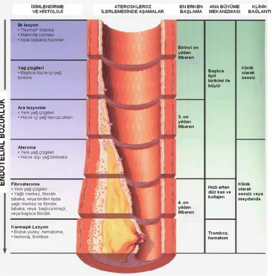 Şekil  1.9:  Aterosklerotik  plağın  progresyonundaki  aşamalar  (Vikipedi  aterojenez tr.png sayfasından alınmıştır) 