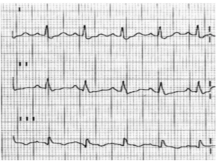 Şekil 3: Akut Sağ Ventrikül yüklenmesini gösteren EKG örneği: d1 derivasyonda  derin  S, d3  derivasyonda  büyük  Q, ve negatif T dalgası görünümü  