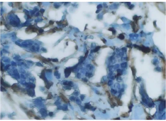 Şekil 3.4. DKK1 negatif tümör hücresi (İHK boyama x400). 