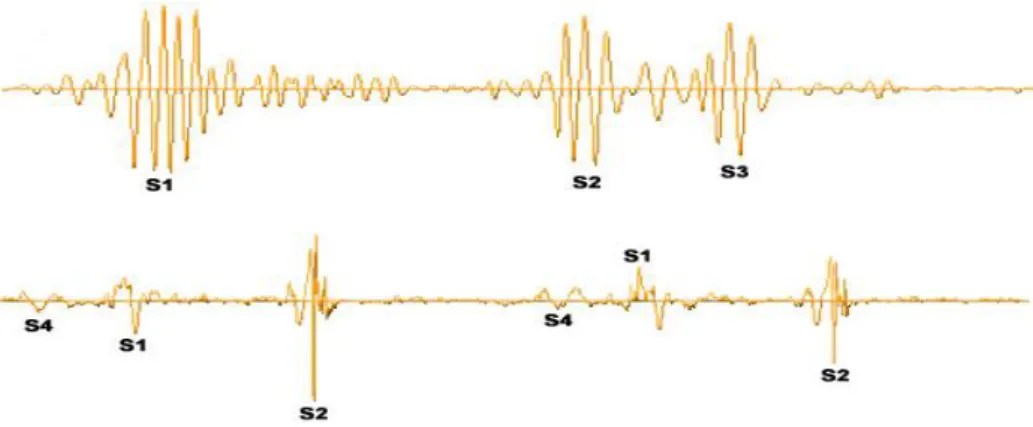 Şekil 3.11. S3 ve S4 normal kalp sesleri (Murphy ve ark., 2002). 