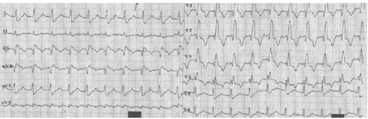 Şekil 8. Akut PE hastasına ait EKG kaydı    
