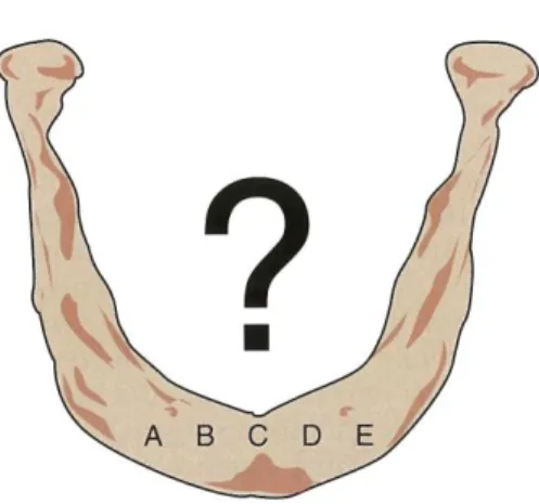 ġekil 1.9. Mental foramenler arası implant yerleĢim bölgeleri (Misch,1999).  Tam diĢsiz hastalarda implant destekli mandibular overdenture protez için beĢ  tedavi seçeneği mevcuttur  (Misch 1989, Misch 1993)