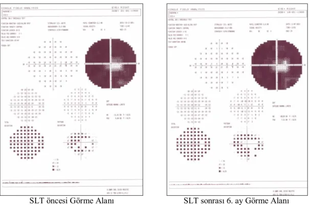 Şekil 2. OHT’li bir olgunun SLT öncesi  ve SLT sonrası 6. ay Görme Alanı testi 