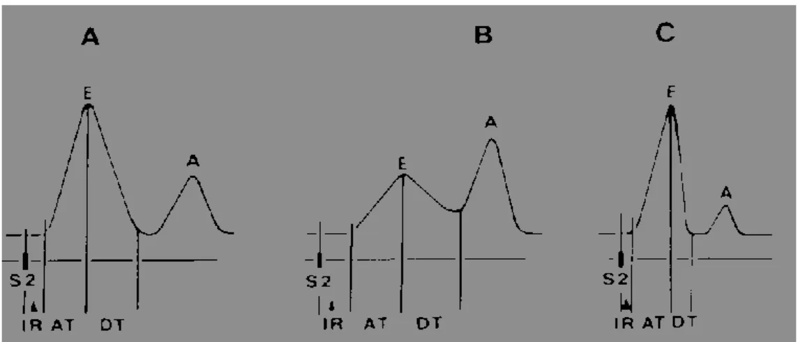 Şekil 1.9. Normal diyastolik doluş ve Diyastolik fonksiyon bozuklukların şematik gösterimi