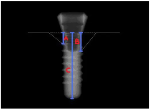 ġekil 2.1. Panoramik radyograflarda kemik kaybı miktarı hesaplanması için Ģekilde belirtilen hatlarda  ölçüm yapıldı