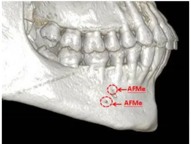 Şekil 3.13.Aksesuar for. mentale (AFMe) görülme oranı. 