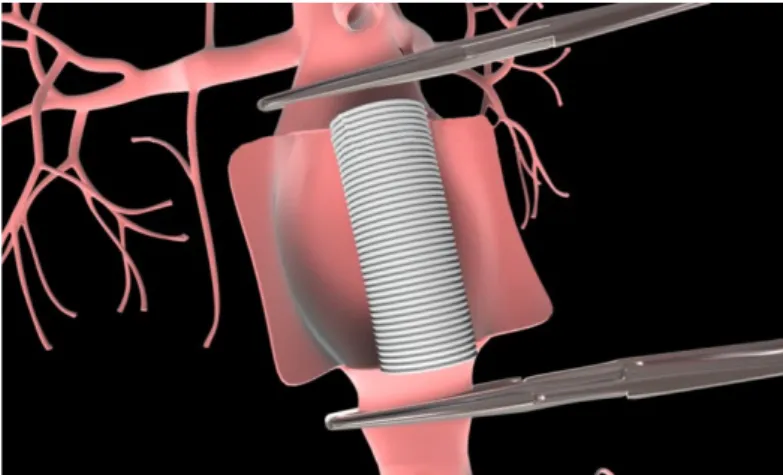 Şekil 1.1:Abdominal aorta anevrizmasının açık cerrahi ile tedavisinde  uygulanan yöntem