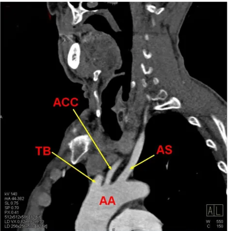 ġekil 3.3. Arcus aortae (AA), truncus brachiocephalicus (TB), arteria carotis  communis (ACC) ve arteria subclavia (AS) olmak üzere 3 dal verdiği olgu