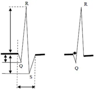 Şekil 3.8. QRS bileşiğini oluşturan değişik dalgalara ilişkin ölçümlerde izlenecek yöntem 