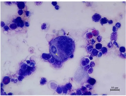 Şekil 4.1.2. Deney grubu sıçanların kemik iliğindeki promegakaryoblast (siyah okla  gösterilen)  tarafından  yutulan  nötrofil  lökosit  (sarı  okla  gösterilen)  ve  yutulan  hücrelerin etrafında gözlenen açık renkteki alan 