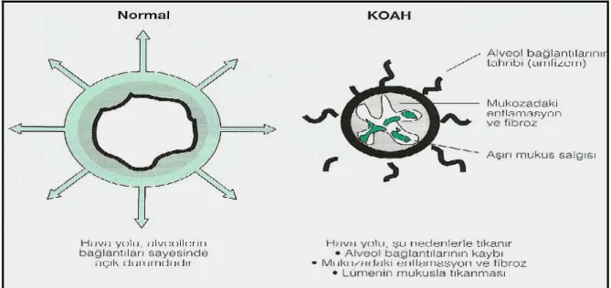 Şekil 2.  KOAH’da hava yolu patolojisi.