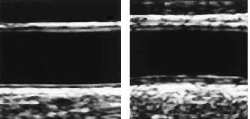 Şekil 2: Solda normal karotis intima-media kalınlığı olan  karotis arter, sağda ise intima media kalınlığı artmış 