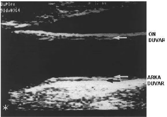 Şekil 4: Ön (yakın) ve arka (uzak) duvarın ultrasonografik görünümü 