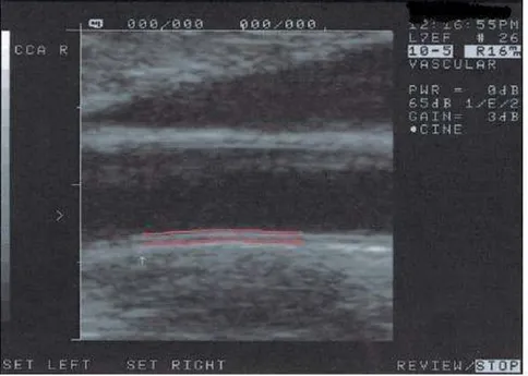 Şekil 5: Karotis intima media kalınlığının ölçülmesi 