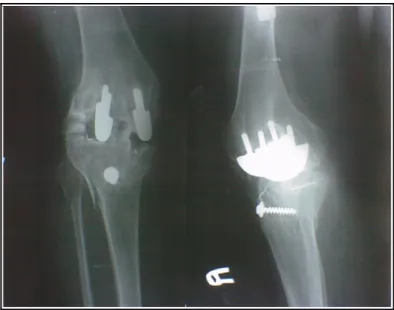 Şekil  2: Dr. Güngör Sami Çakırgil’in uyguladığı diz protezi(9) 