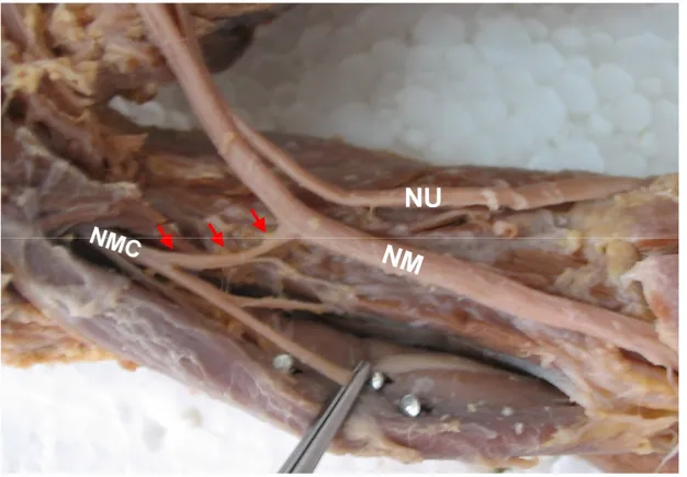 Şekil  6.  34  haftalık  fetusta  n.  musculocutaneus  (NMC)  ile  n.  medianus  (NM)  arasında  distalden çıkan bağlantı dalı
