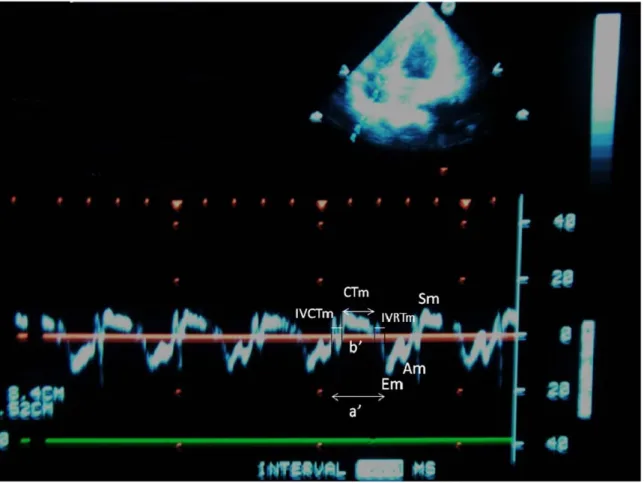 Şekil 9: Doku Doppler yöntemi ile miyokard performans indeks ölçüm değerleri  (septumun sağından)