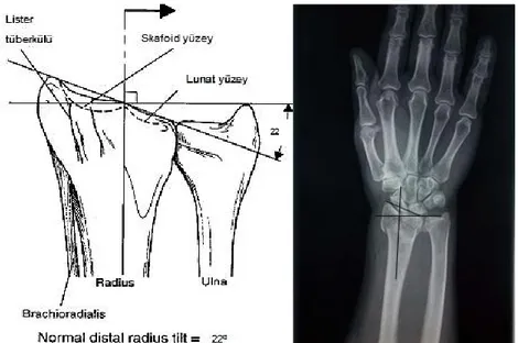 Şekil 7: Dorsal açılanma             