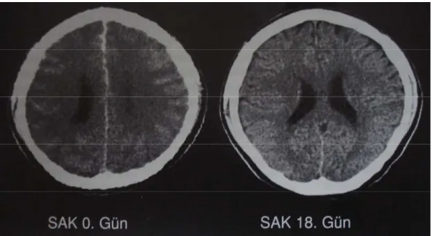 Şekil 5: Beyin ödemi. SAK sonrası hastanın gri ak madde ayrımı yapılamıyor. 