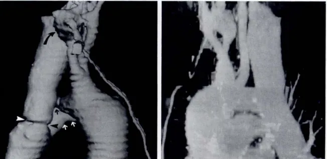 Şekil 10 : SSD (a) ve MİP (b) imajlarda aortanın kompleks anatomisi gösterilmektedir. 