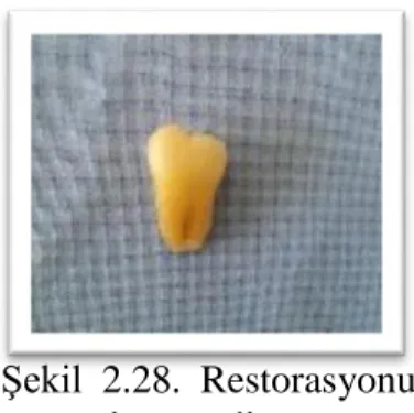 Şekil  2.28.  Restorasyonu  tamamlanmış diş. 