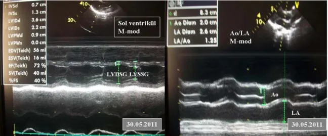 Şekil 1. Sol ventrikül, aort kökü ve sol atriyumun parasternal uzun aks M-mode  ölçümleri  (Ao: Aort kökü, LA: Sol atriyum genişliği, LVDSG: Sol ventrikül diyastol sonu genişlik,  LVSSG: Sol ventrikül sistol sonu genişlik).