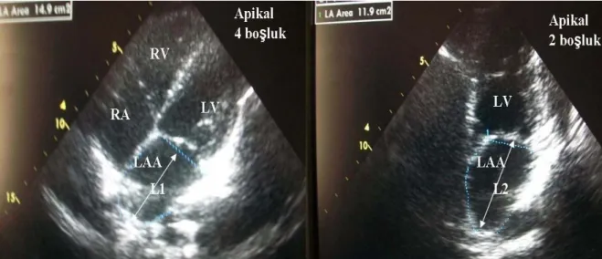 Şekil 6. Sol atriyal apikal dört boşluk ve iki boşluk alan-uzunluk ölçümleri. 