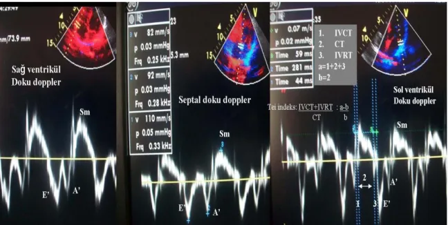 Şekil 9. Sol ventrikül, interventriküler septum ve sağ ventriküle ait doku Doppler ve  Tei indeksi ölçümleri